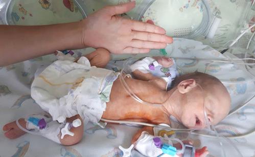 Херсонському малюку провели екстрену унікальну операцію на серці