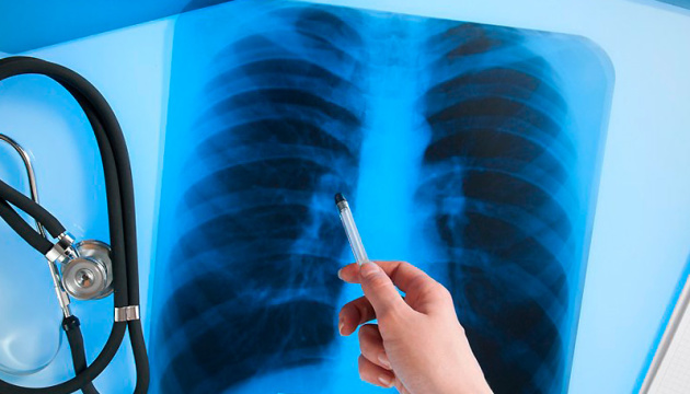 На Херсонщині обговорили важливість вчасного виявлення туберкульозу
