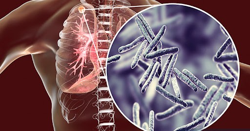 Медична 3D-ілюстрація, що зображує легені людини з вогнищем інфекції. У збільшеному круглому вікні показано паличкоподібні бактерії (мікобактерії), які є збудниками туберкульозу.