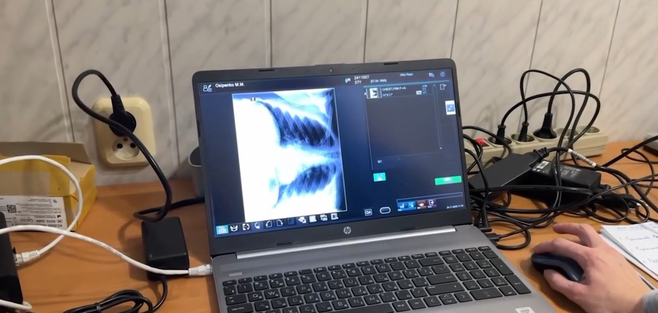 Ноутбук HP, на екрані якого відображено рентгенівський знімок грудної клітки (легені). На знімку видно частину легені та ребра, а також дані пацієнта. Права рука користувача керує бездротовою мишею. На задньому плані видно робочий стіл із великою кількістю сплутаних проводів, подовжувачів та електричних розеток.